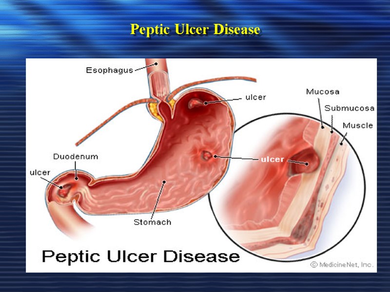 Peptic Ulcer Disease